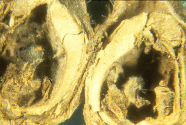 Grisly scene of remains of 2 weevil larvae in nut that has totally decayed.